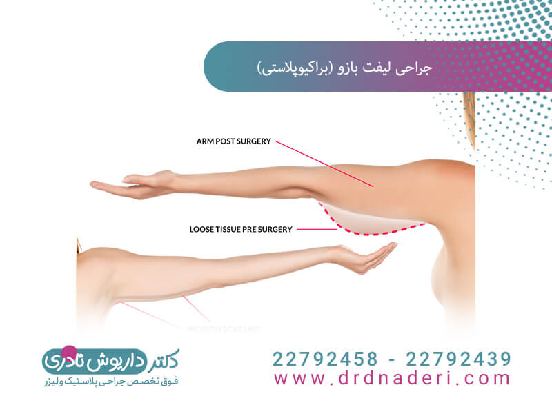 جراحی لیفت بازو
