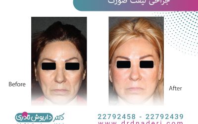 جراحی لیفت صورت تجربه دوباره جوانی + نمونه کار و فیلم واقعی