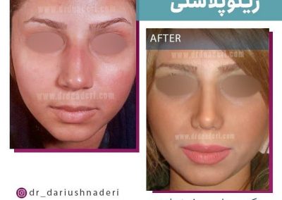 با جراحی بینی چهره ای متفاوت را تجربه کنید.