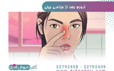 تورم بعد از عمل بینی