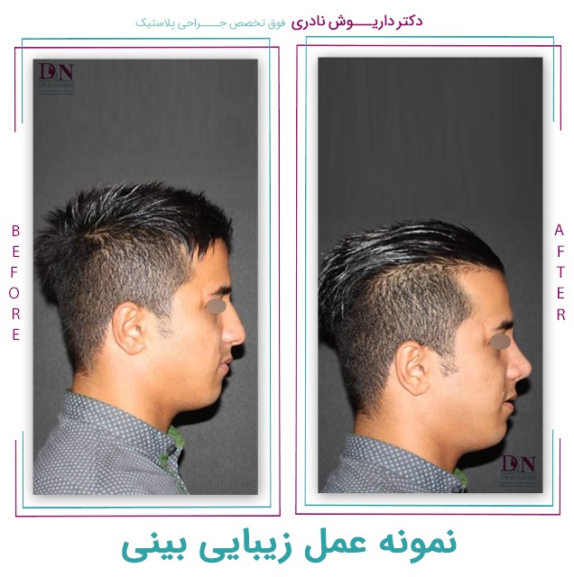نمونه راینوپلاستی در مردان در تهران