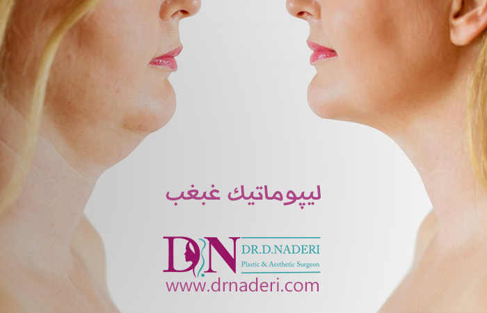 رفع-غبغب-با-لیپوماتیک