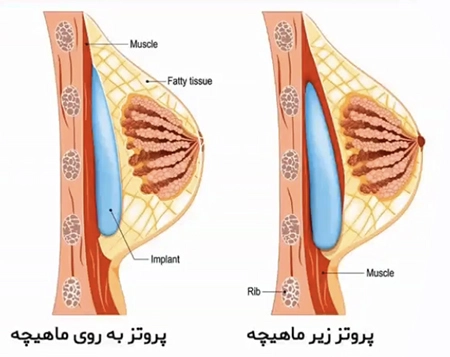 محل قرارگیری پروتز سینه
