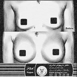 نمونه کار جراحی بزرگ کردن سینه