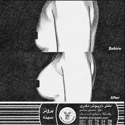 نمونه کار پروتز پستان