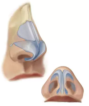 پیوند غضروف سپتوم بینی
