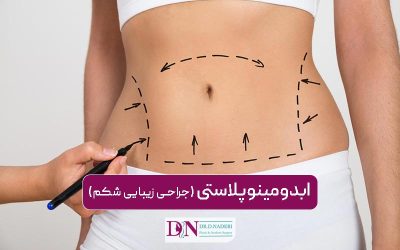 ابدومینوپلاستی (جراحی زیبایی شکم)