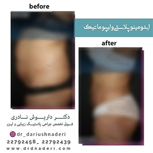 ابدومینوپلاستی-و-لیپوماتیک