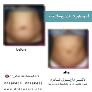 عمل-همزمان-لیپوماتیک-و-ابدومینوپلاستی