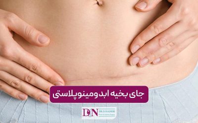 جای بخیه ابدومینوپلاستی + معرفی روش های تضمینی برای رفع آن