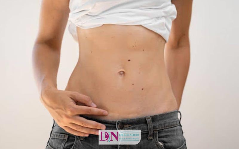 نقش گن طبی و فشار وارده آن بر کاهش جای بخیه و زخم بعد از عمل ابدو