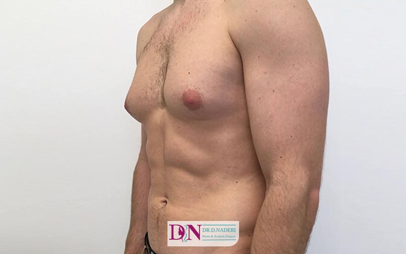 مراحل تشخیص بزرگی سینه در مردان یا Gynecomastia چیست