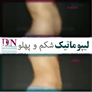قبل-و-بعد-عمل-لیپوماتیک-شکم-و-پهلو