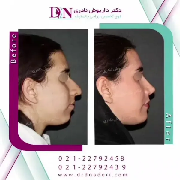 بهترین جراح بینی استخوانی
