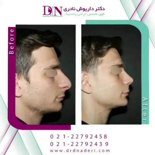 بهترین جراح بینی استخوانی