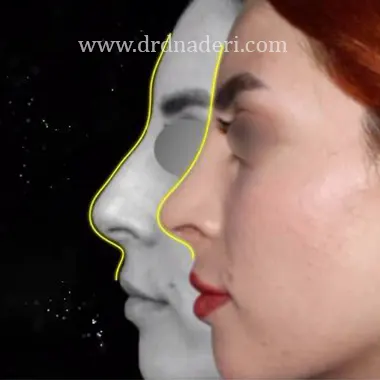 بهترین جراح بینی استخوانی