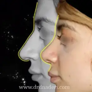 ویژگی های بهترین جراح بینی استخوانی در تهران