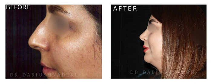 نتیجه جراحی بینی توسط دکتر داریوش نادری