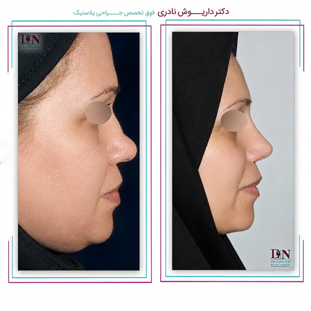 نتایج عمل بینی توسط دکتر نادری