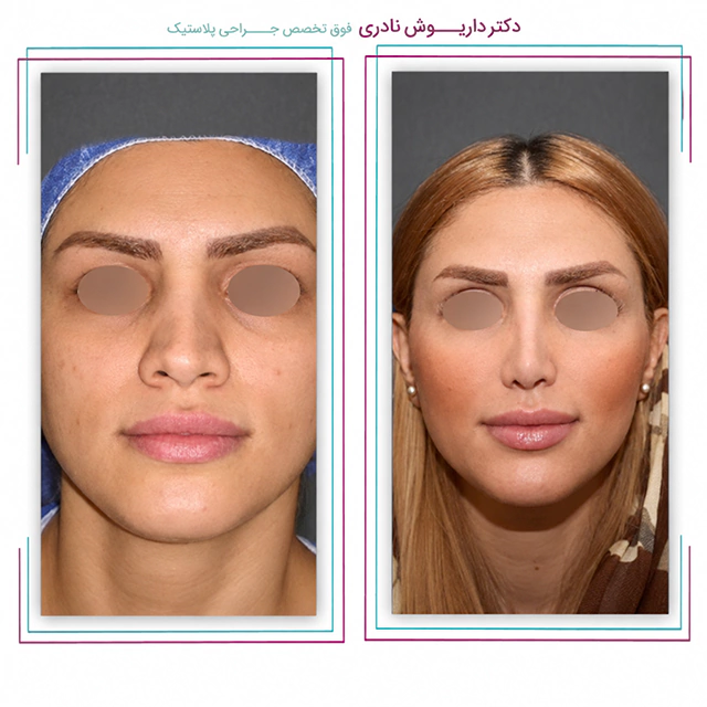 نمونه عمل بنی توسط دکتر داریوش نادری