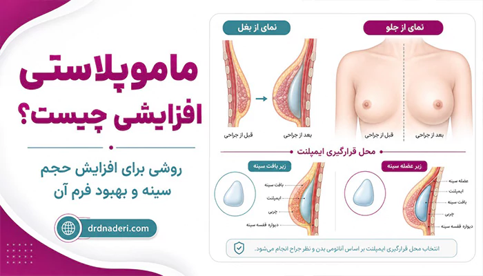 جراحی ماموپلاستی افزایشی