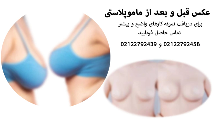 عکس قبل و بعد از ماموپلاستی